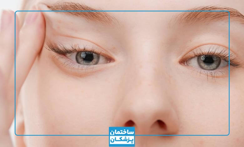 عوامل موثر بر هزینه لیفت شقیقه