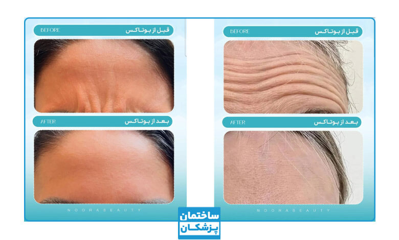 قبل و بعد از تزریق بوتاکس توسط دکتر مولوی