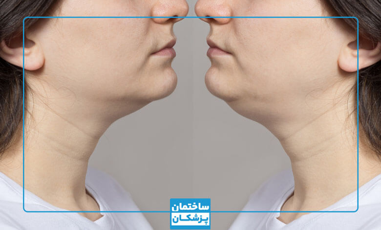 بهترین دکتر رفع غبغب در شیراز چه کسی است؟