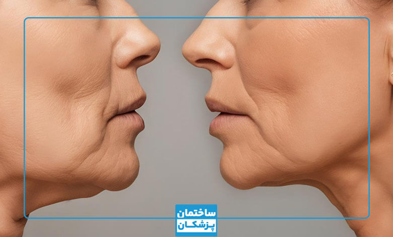 بهترین دکتر رفع غبغب در شیراز