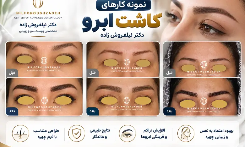 نمونه کار کاشت ابرو نیلفروش زاده