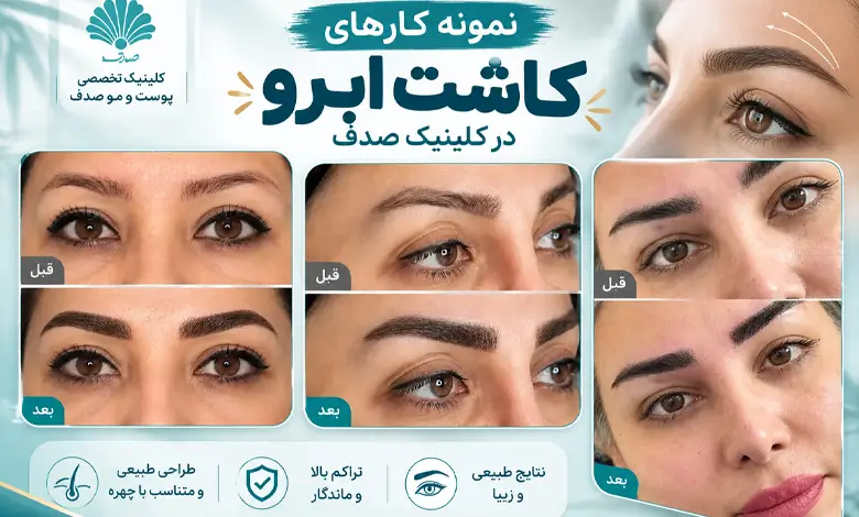 نمونه کارهای کاشت ابرو کلینیک صدف