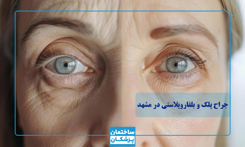 بهترین جراح پلک در مشهد