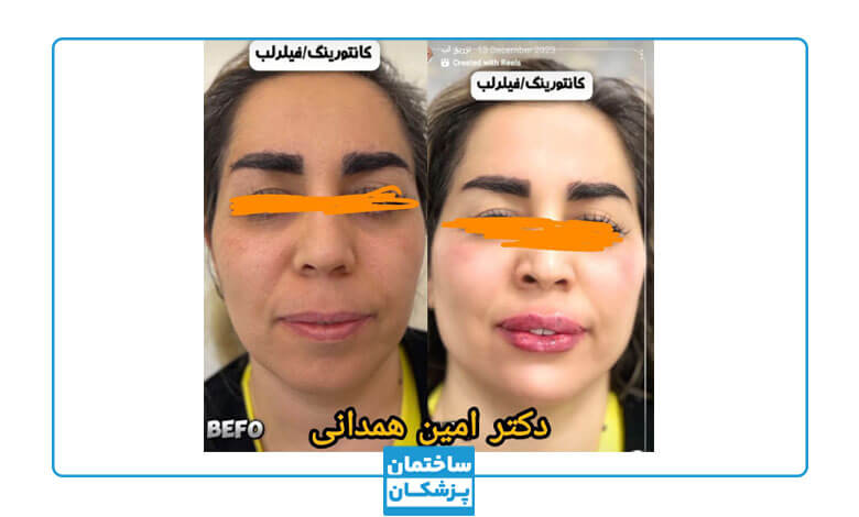 نمونه کار کانتورینگ صورت توسط دکتر همدانی