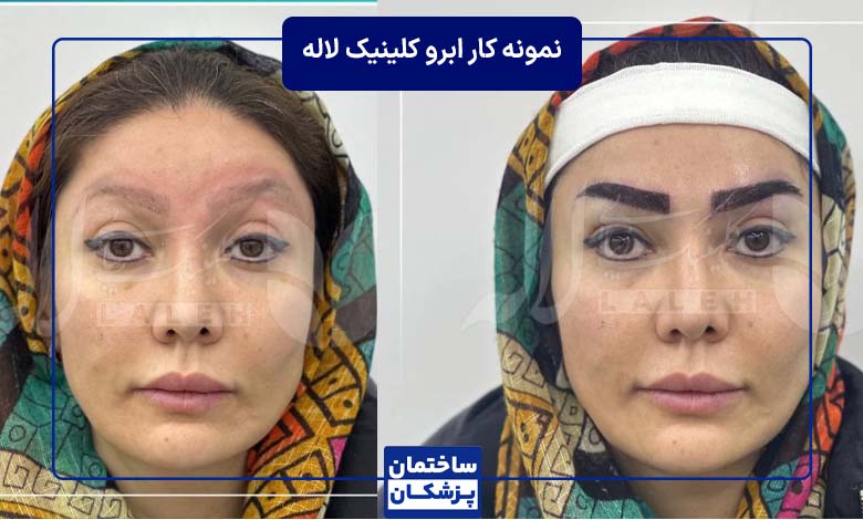 نمونه کار کاشت ابرو کلینیک لاله