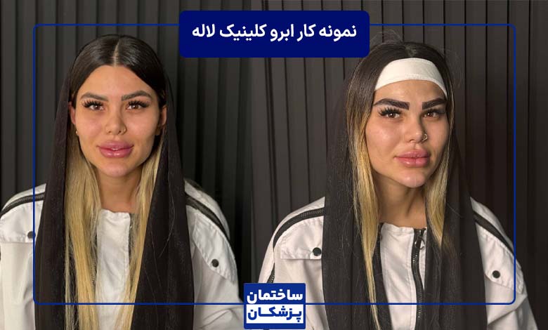 عکس قبل و بعد کاشت ابرو در کلینیک لاله