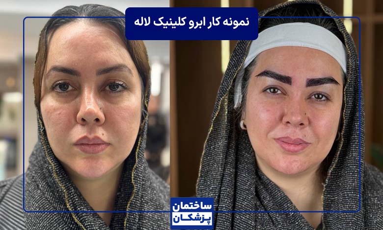 کاشت ابرو قبل و بعد در کلینیک لاله