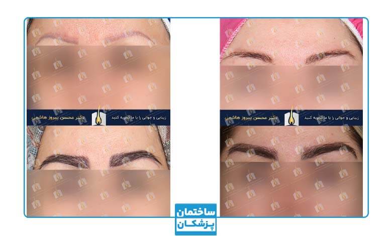 نمونه کار کاشت ابرو قبل و بعد در کلینیک تصویر جوانی