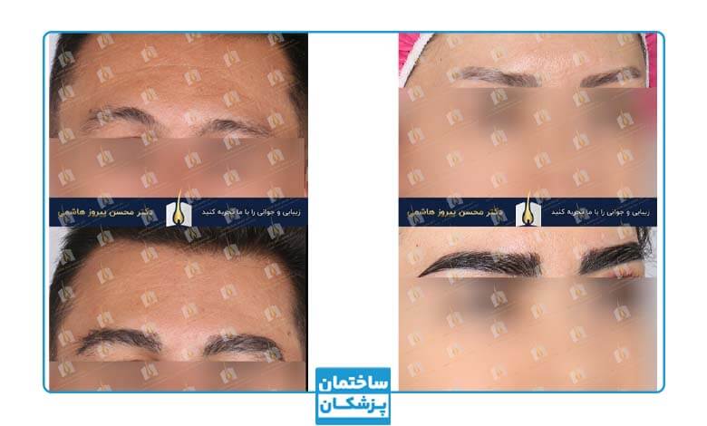 نمونه کار کاشت ابرو قبل و بعد در کلینیک تصویر جوانی