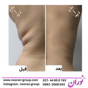 لاغری کمر و پهلو با دستگاه ار اف و کویتیشن در کلینیک نوران