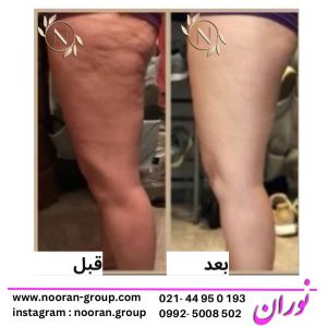 رفع سلولیت و لاغری پا