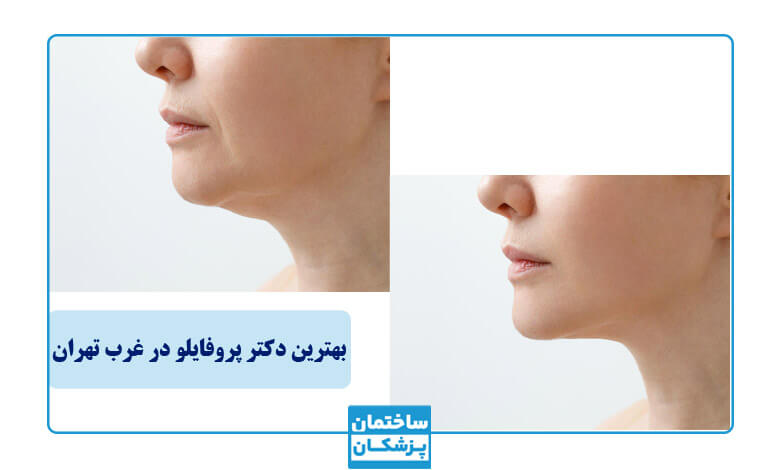قبل و بعد از تزریق پروفایلو