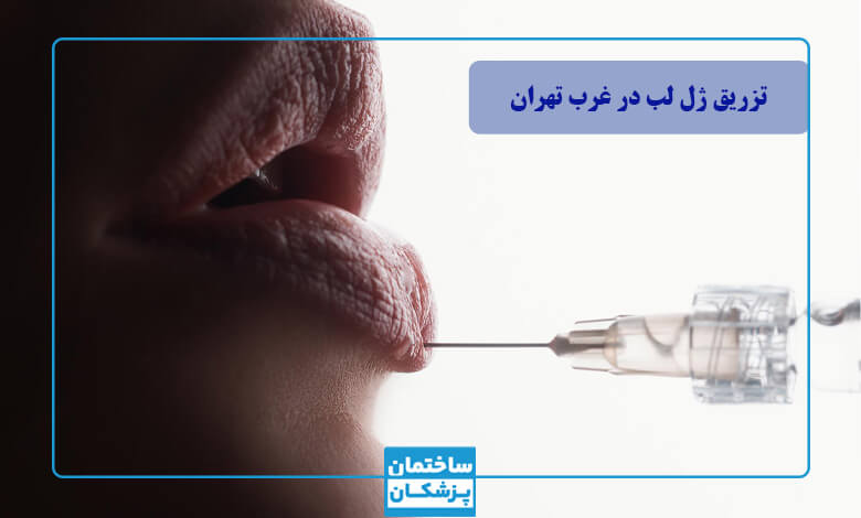 لیست بهترین دکتر تزریق ژل لب در غرب تهران