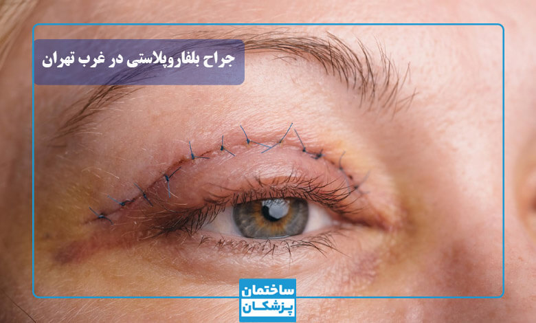 هزینه بلفاروپلاستی در غرب تهران چقدر است؟