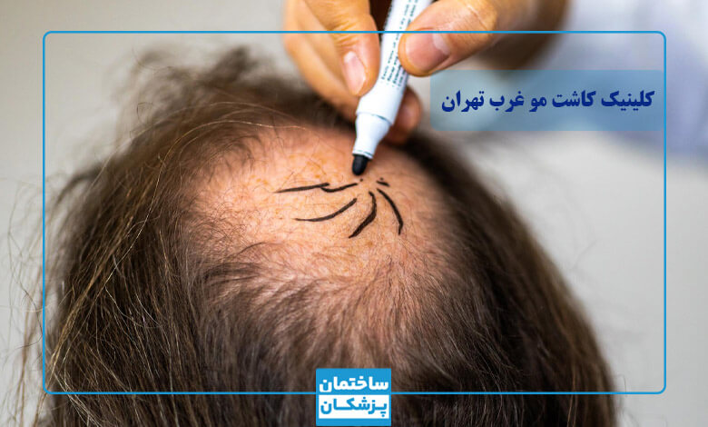 انواع روش های کاشت مو در غرب تهران