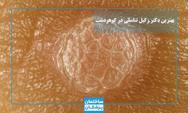 درمان زگیل تناسلی در گوهردشت