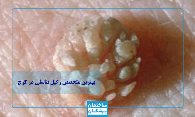 معیارهای مهم در انتخاب بهترین متخصص زگیل تناسلی در کرج