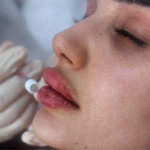 تزریق ژل لب در کلینیک نوران