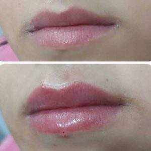 قبل و بعد از تزریق ژل لب در کلینی نوران