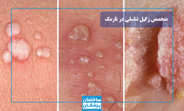 زگیل تناسلی چیست و چه علائمی دارد؟
