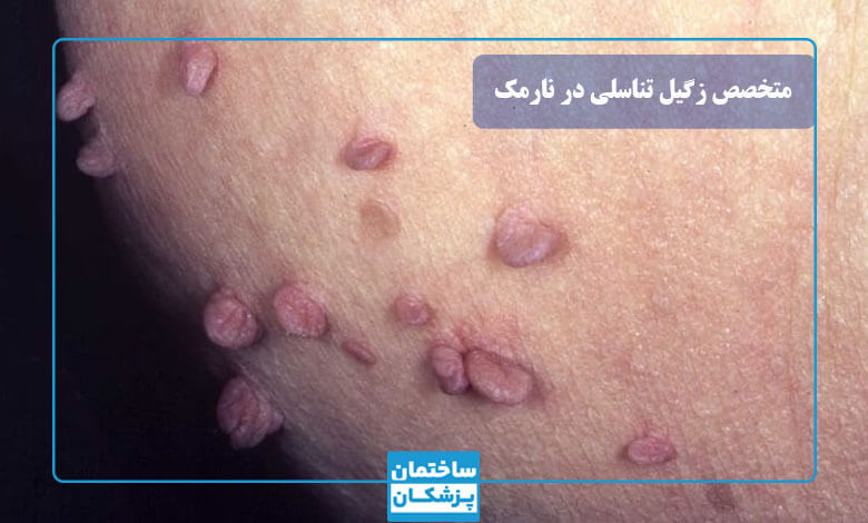 تشخیص زگیل تناسلی توسط بهترین متخصص نارمک