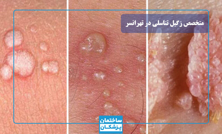 برای درمان زگیل تناسلی به چه دکتری مراجعه کنیم؟