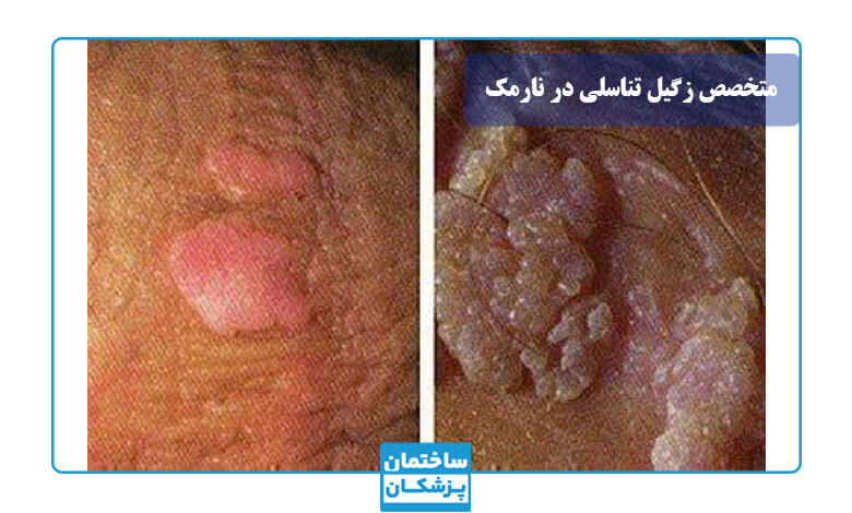 برای درمان زگیل تناسلی به چه دکتری مراجعه کنیم؟