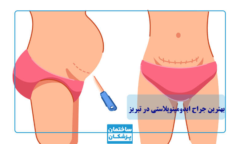 ابدومینوپلاستی چیست