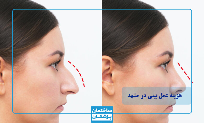 هزینه و قیمت عمل بینی در مشهد