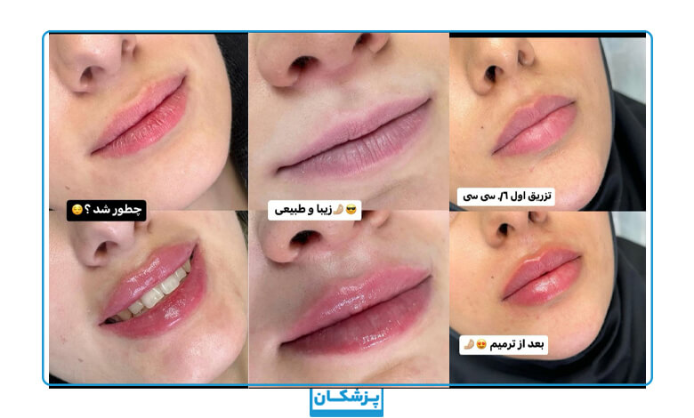 نمونه کار تزریق ژل لب در صدف بیوتی لند