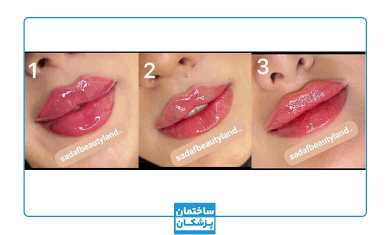 تزریق ژل لب در کلینیک صدف بیوتی لند
