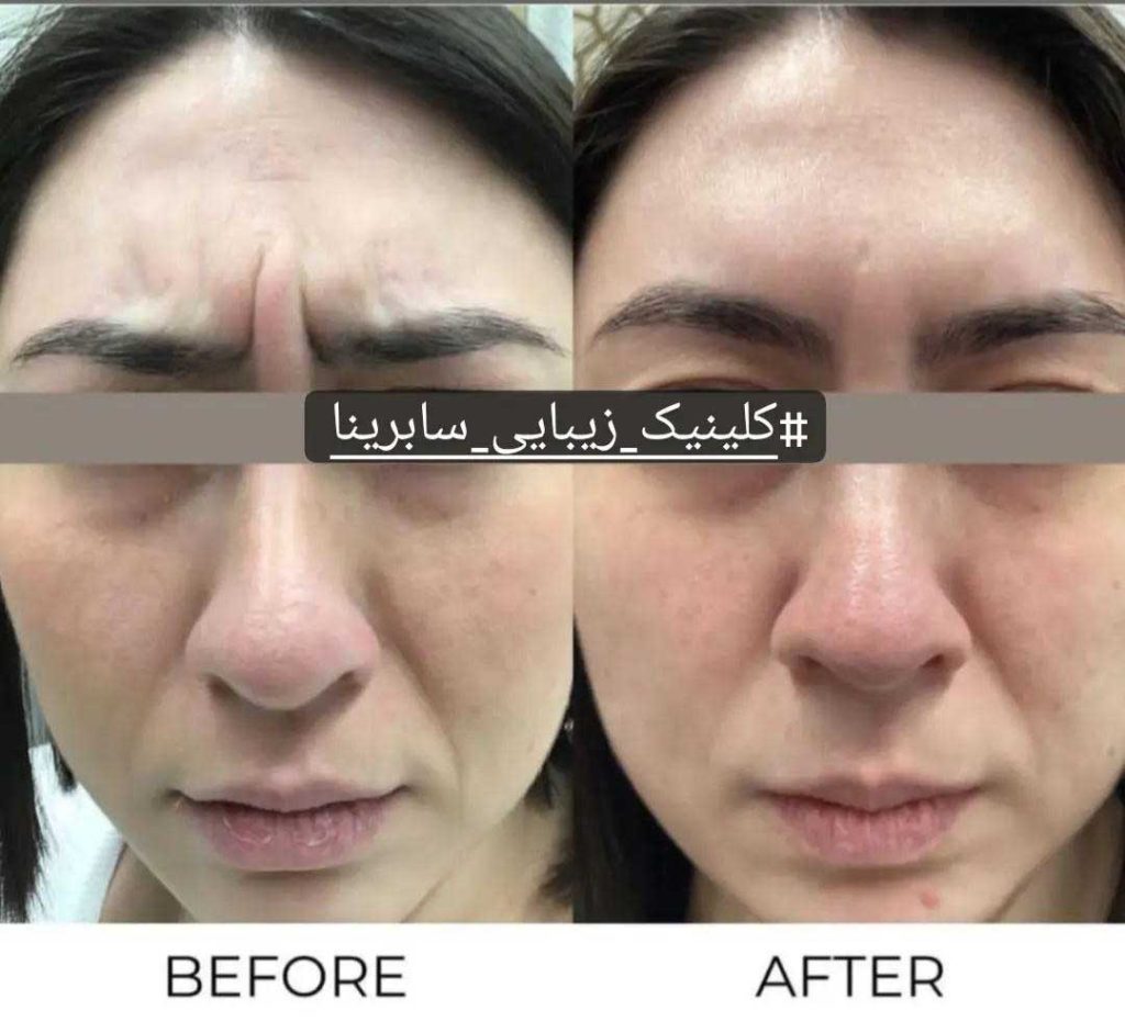نمونه کار تزریق بوتاکس کلینیک سابرینا