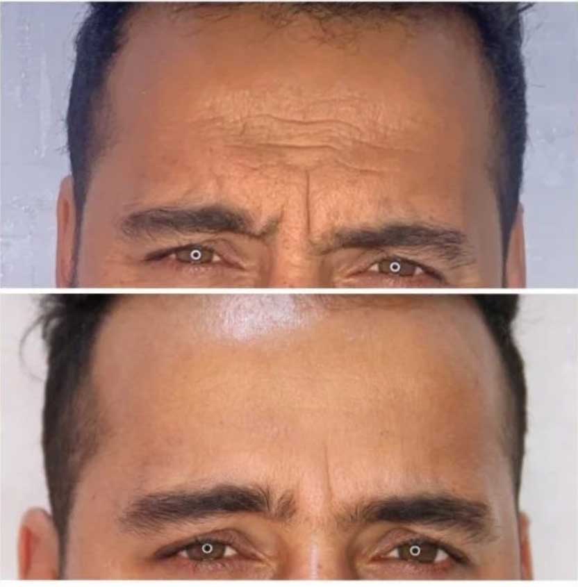 قبل و بعد از ترمیم بوتاکس پیشانی در کلینیک سابرینا