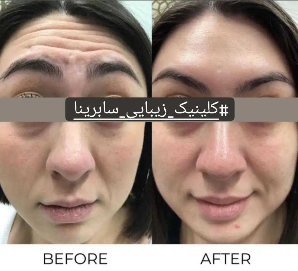 نمونه کار تزریق بوتاکس پیشانی کلینیک سابرینا