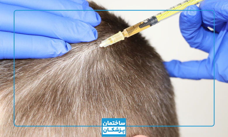 مزوتراپی مو چیست