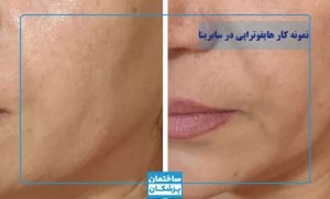 نمونه کار هایفوتراپی سابرینا