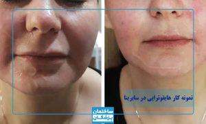 نمونه کار هایفوتراپی سابرینا