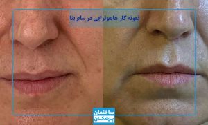 نمونه کار هایفوتراپی سابرینا