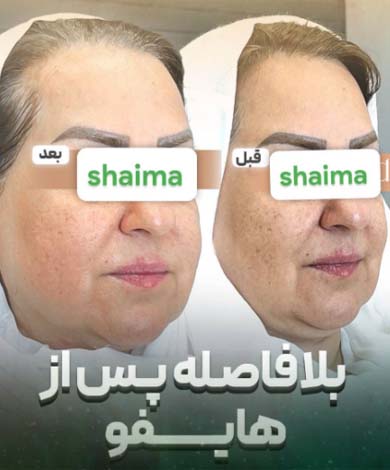 بلافاصله بعد از هایفوتراپی در کلینیک شایما