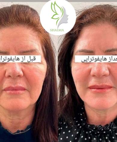 قبل و بعد از هایفوتراپی در کلینیک زیبایی شایما