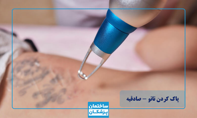لیست ده تایی بهترین مرکز پاک کردن تاتو با لیزر در صادقیه