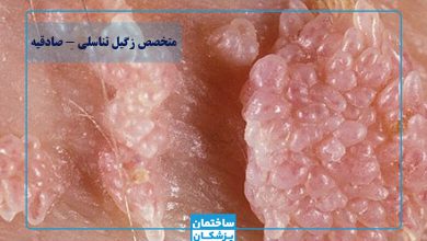 بهترین متخصص زگیل تناسلی در صادقیه