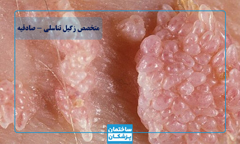 بهترین متخصص زگیل تناسلی در صادقیه
