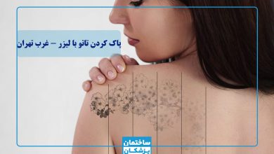 بهترین مرکز پاک کردن تاتو با لیزر در غرب تهران