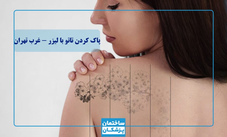 بهترین مرکز پاک کردن تاتو با لیزر در غرب تهران