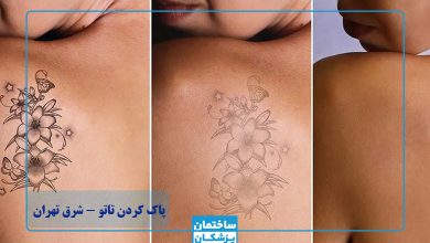 بهترین مرکز پاک کردن تاتو با لیزر در شرق تهران