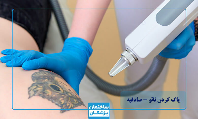 بهترین مرکز پاک کردن تاتو با لیزر در صادقیه