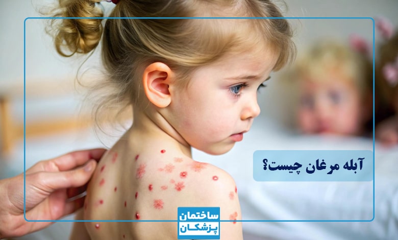 آبله مرغان چیست؟
