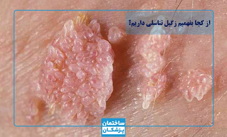 از کجا بفهمیم زگیل تناسلی داریم - تشخیص زگیل تناسلی