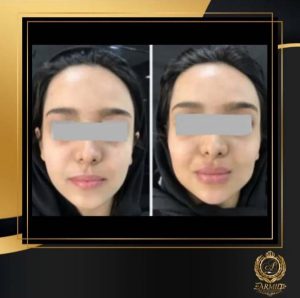 نمونه کار زاویه سازی صورت با دکتر امید